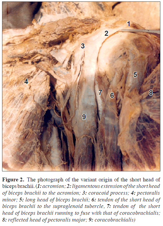 anatomical-variations-acromion