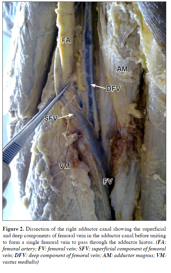 superficial and deep components of femoral vein in the adductor canal befor...