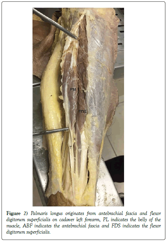 anatomical-variations-antebrachial-fascia