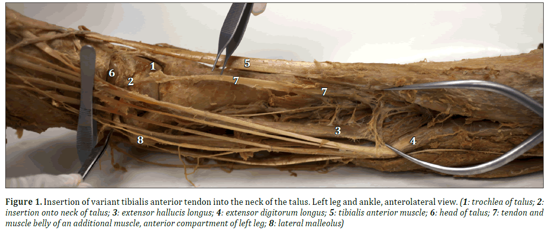 anatomical-variations-anterior-muscle