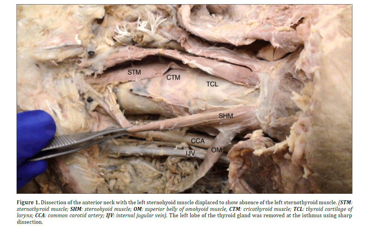anatomical-variations-anterior-neck