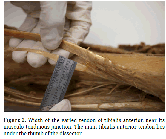 anatomical-variations-anterior-tendon