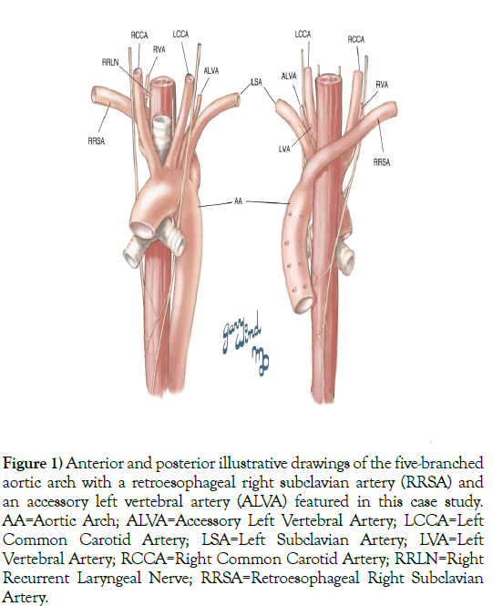 anatomical-variations-aortic-arch