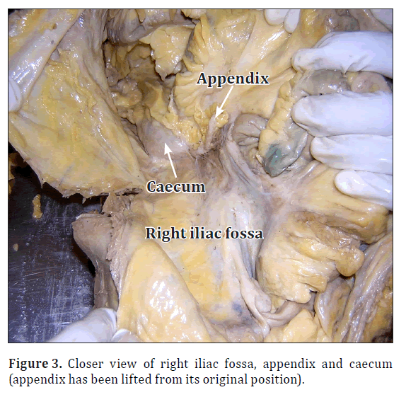 anatomical-variations-appendix-caecum