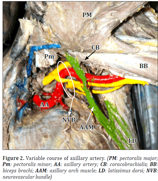 anatomical-variations-axillary-artery