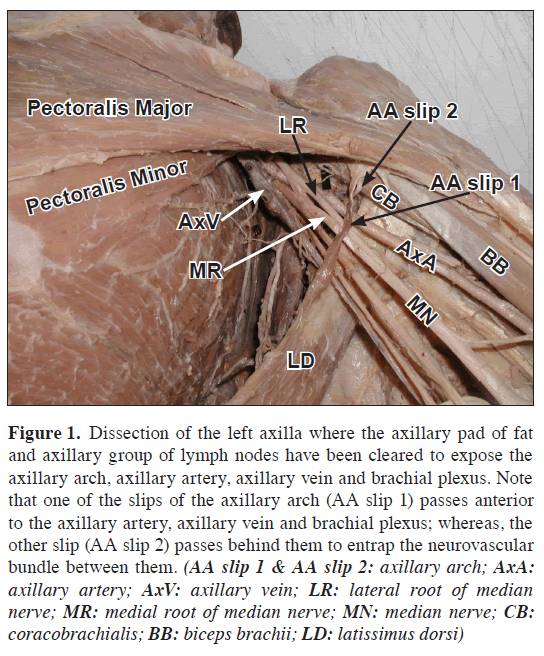 anatomical-variations-axillary-pad