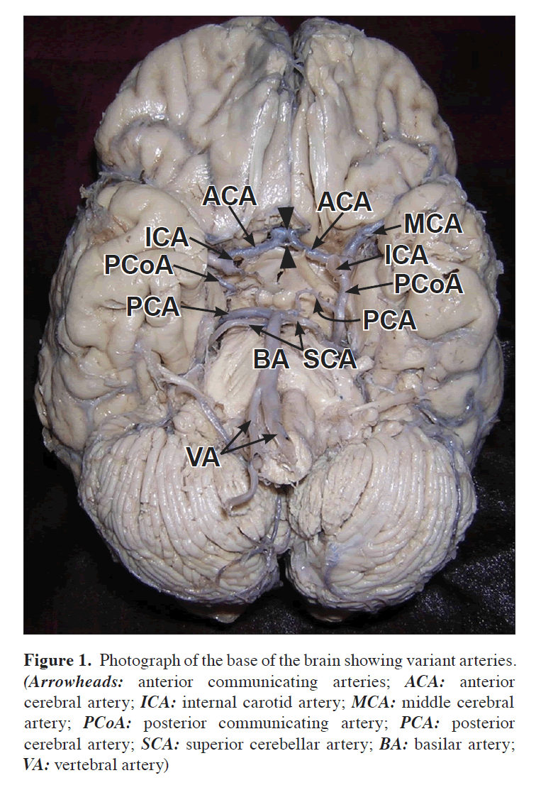 anatomical-variations-base-brain