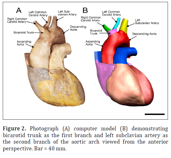 anatomical-variations-bicarotid-trunk