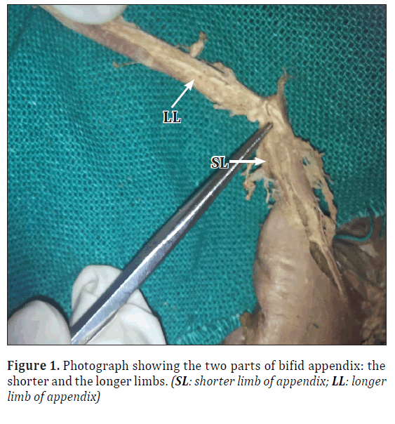 anatomical-variations-bifid-appendix