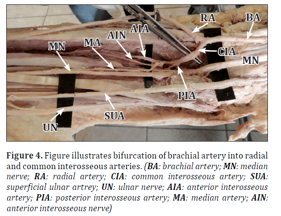 anatomical-variations-bifurcation-brachial