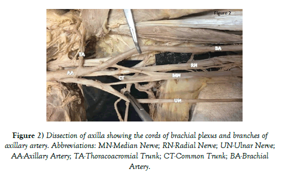 anatomical-variations-brachial-plexus