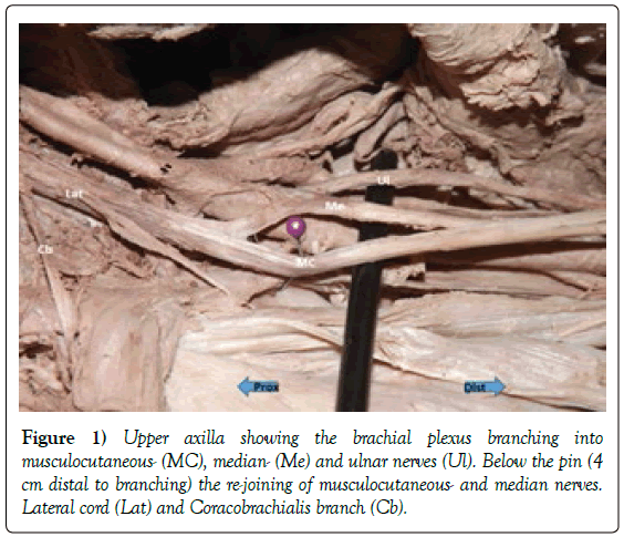 anatomical-variations-brachial-plexus