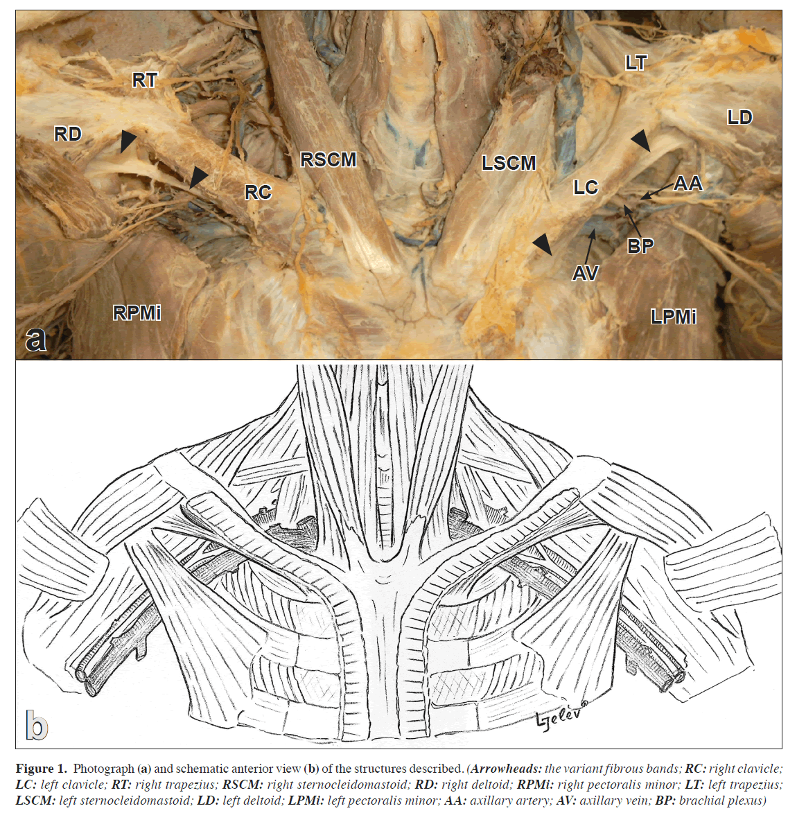 anatomical-variations-brachial-plexus