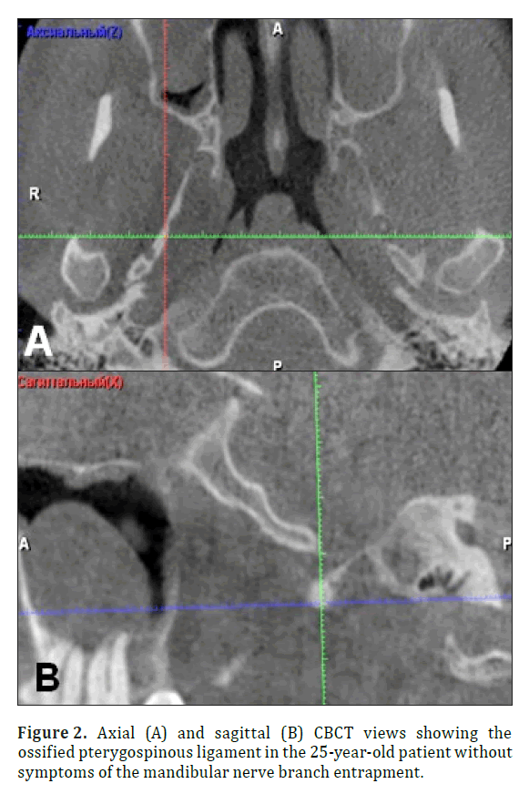 anatomical-variations-branch-entrapment