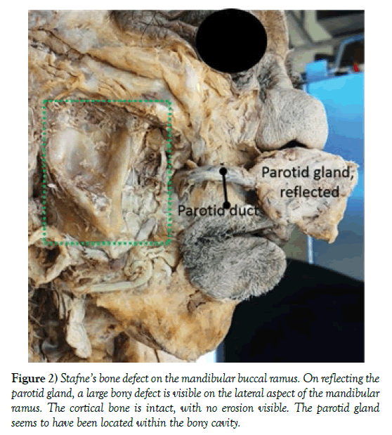 anatomical-variations-buccal-ramus