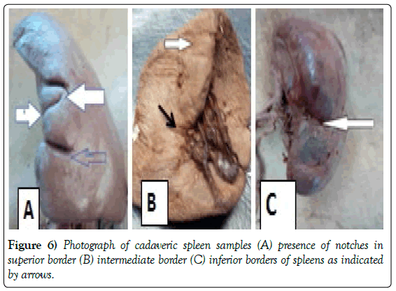 anatomical-variations-cadaveric-spleen