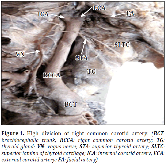 anatomical-variations-carotid-artery