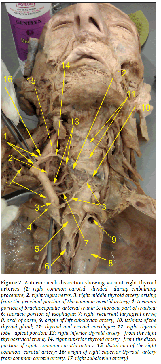 anatomical-variations-carotid-artery