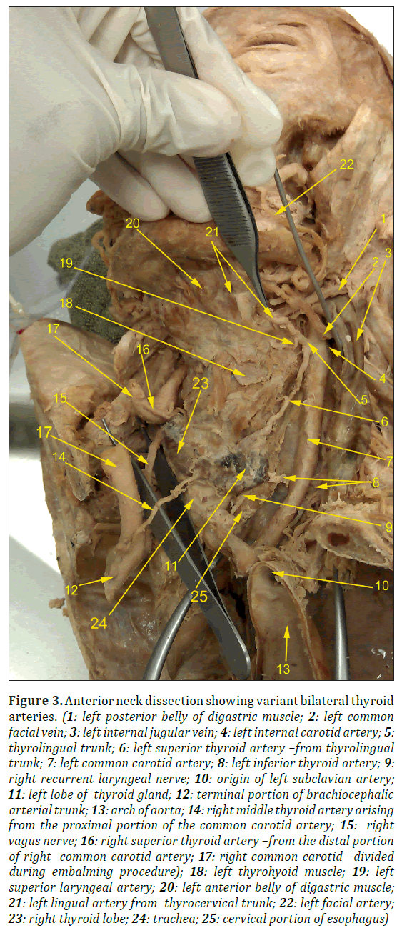 anatomical-variations-carotid-belly