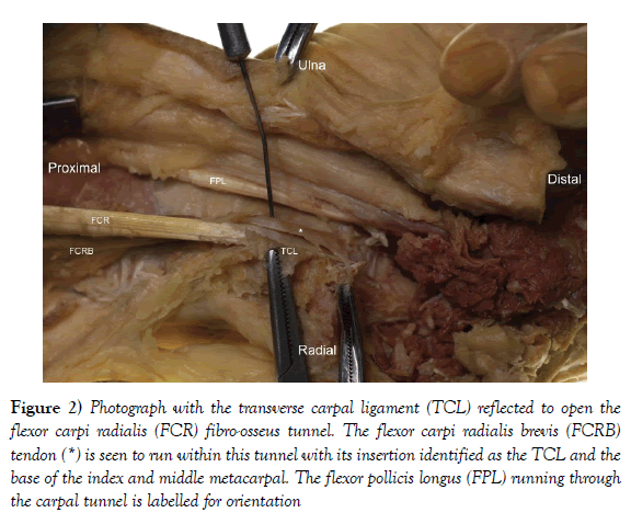 anatomical-variations-carpal-ligament