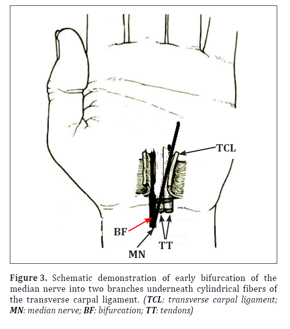 anatomical-variations-carpal-ligament