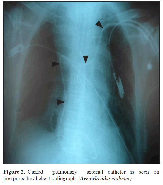 anatomical-variations-catheter