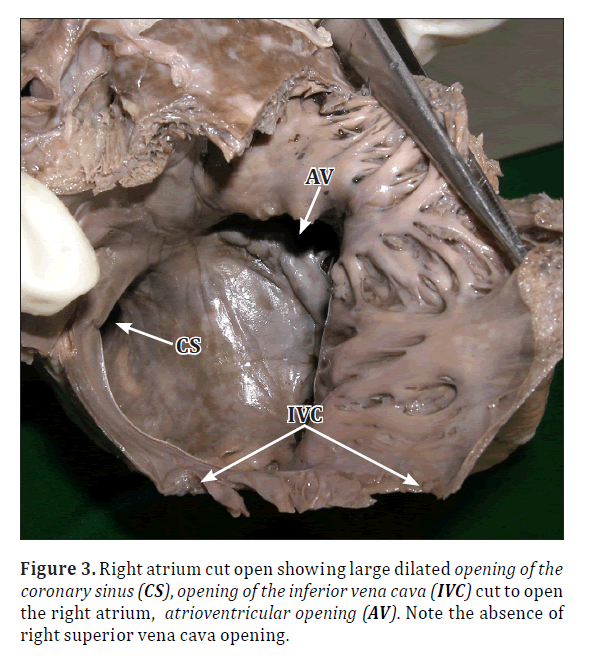 anatomical-variations-cava-opening