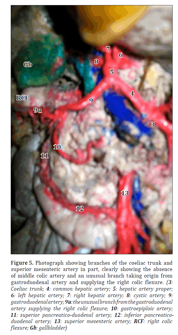 anatomical-variations-colic-flexure