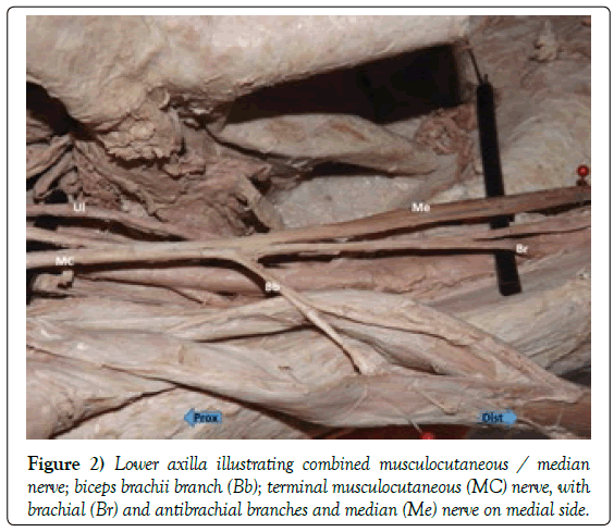 anatomical-variations-combined-musculocutaneous