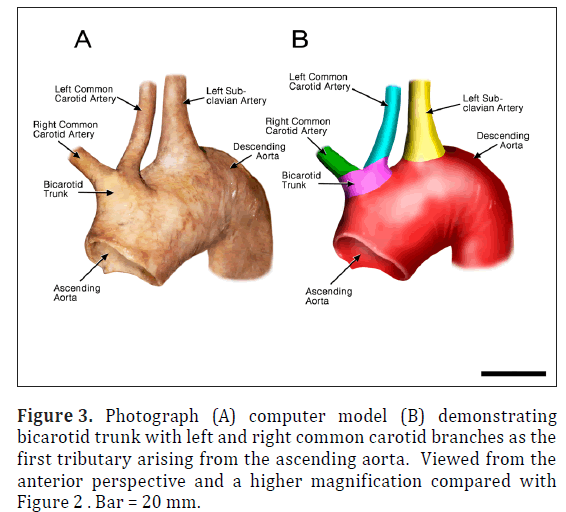 anatomical-variations-common-carotid