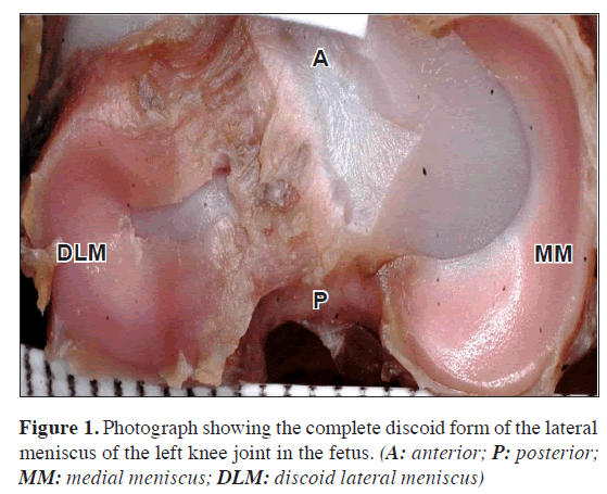 anatomical-variations-complete-discoid