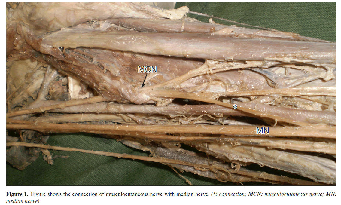 anatomical-variations-connection-musculocutaneous