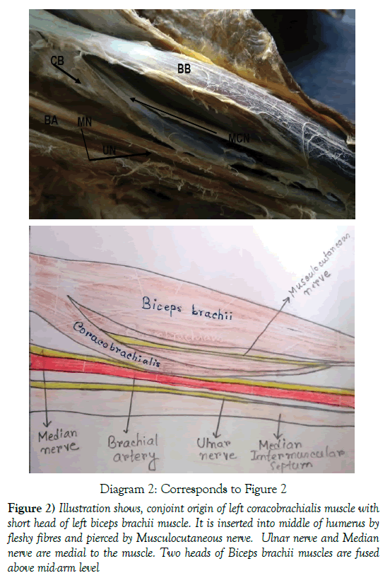 anatomical-variations-coracobrachialis-muscle