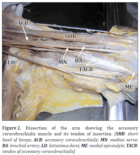 anatomical-variations-coracobrachialis-muscle