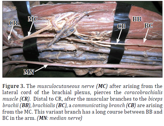 anatomical-variations-cord-plexus