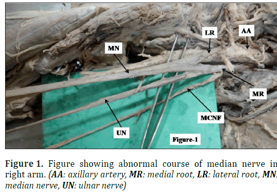 Medial Root of Median Nerve (Right)