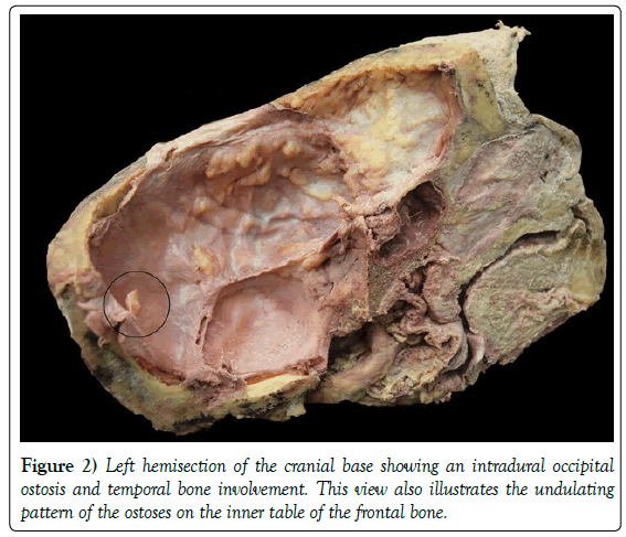 anatomical-variations-cranial-base