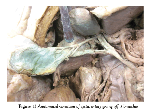 anatomical-variations-cystic-artery