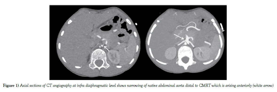 anatomical-variations-diaphragmatic-level