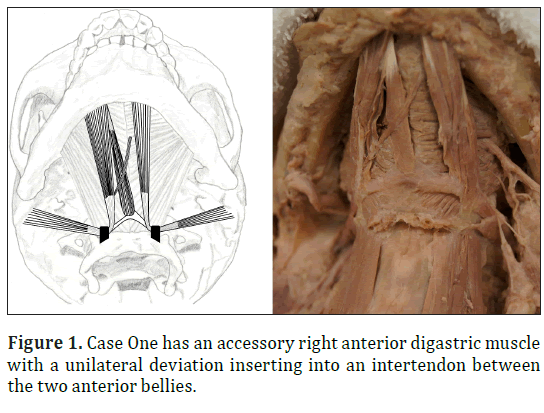 anatomical-variations-digastric-muscle