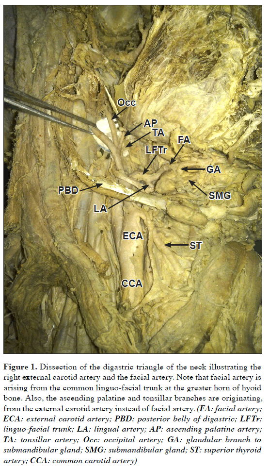 anatomical-variations-digastric-triangle