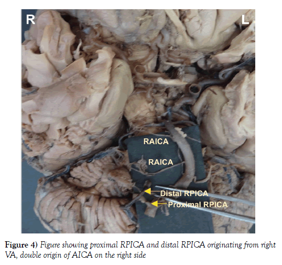 anatomical-variations-distal-RPICA
