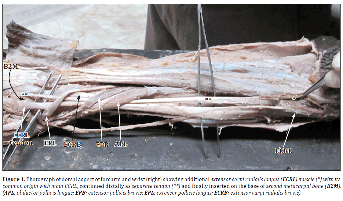 unilateral variation of extensor carpi radialis longus muscle a