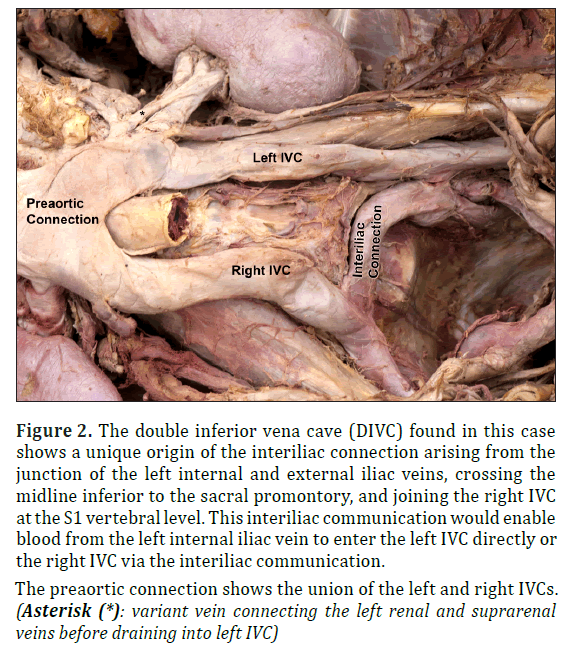 anatomical-variations-double-inferior