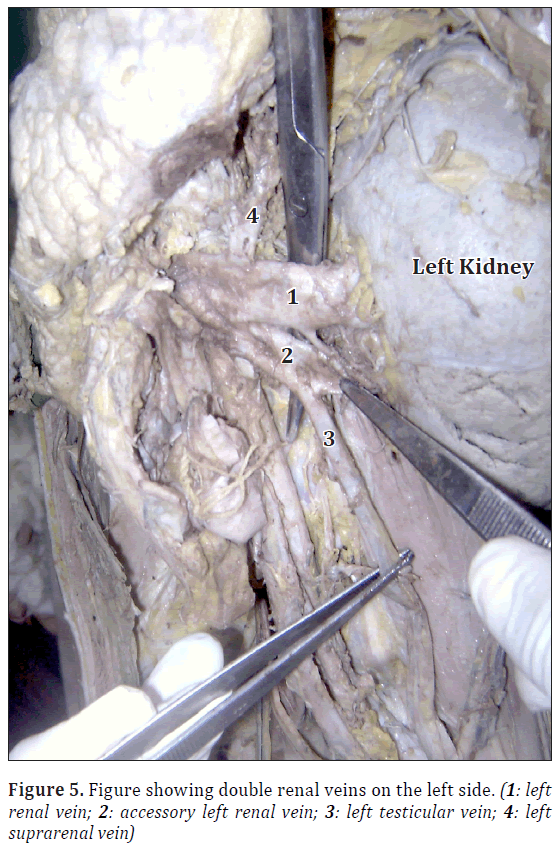 anatomical-variations-double-renal