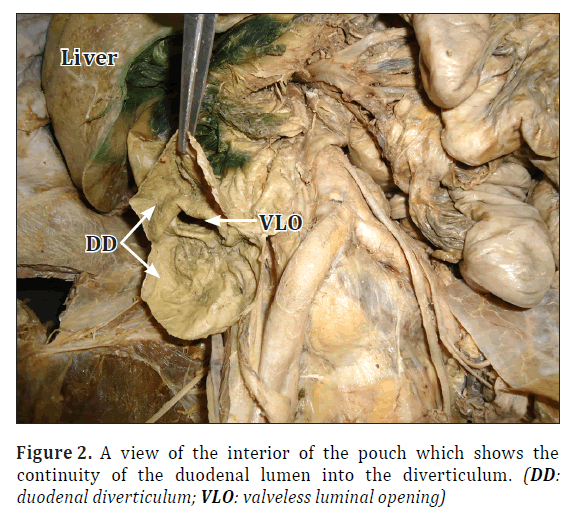 anatomical-variations-duodenal-lumen