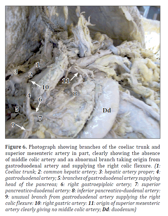 anatomical-variations-duodenum