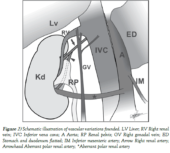 anatomical-variations-duodenum-flatted