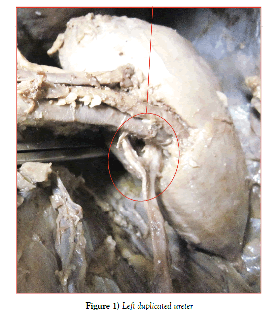 anatomical-variations-duplicated-ureter