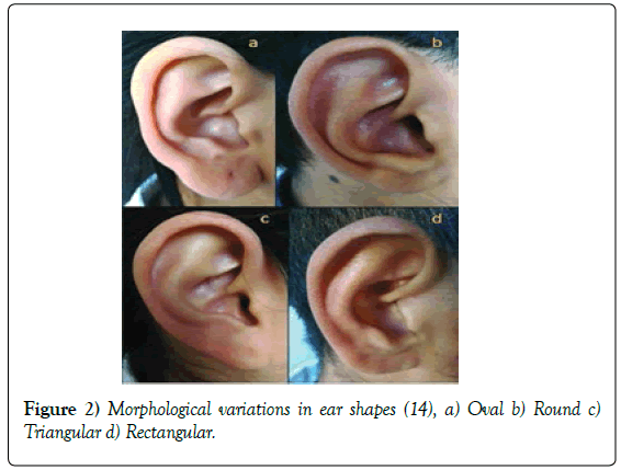 anatomical-variations-ear-shapes